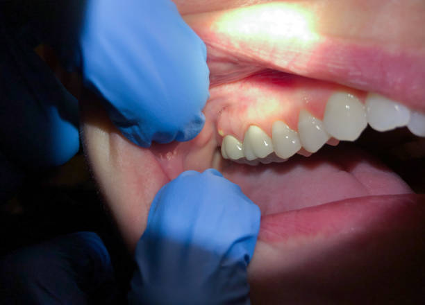 Best Emergency Wisdom Teeth Removal in Port St John, FL